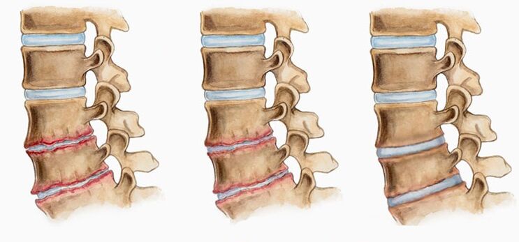 Eine Verformung der Bandscheiben bei Osteochondrose kann Rückenschmerzen verursachen