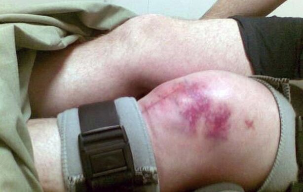 Die Ursachen der Arthrose des Kniegelenks