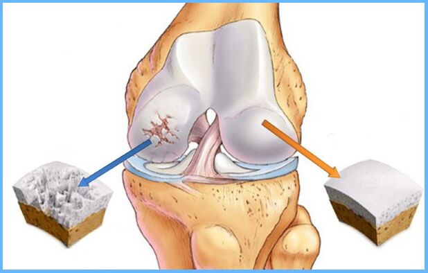 Kniegelenks -Osteoarthritis