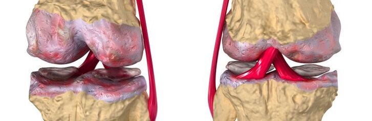 Gesunde Artikulation und Arthrose des Kniegelenks