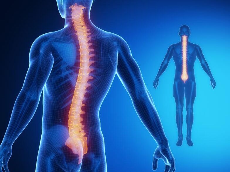 Osteochondrose der Wirbelsäule, die eine komplexe Behandlung erfordert.