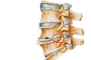 eingeklemmte Bandscheibe der Wirbelsäule als Ursache für zervikale Osteochondrose