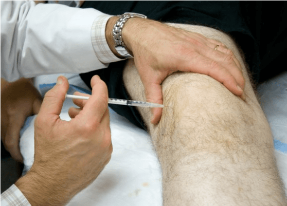 Intra -kartikuläre Verabreichung von Analgetika bei starken Schmerzen
