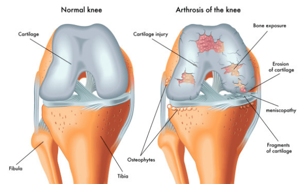 Normale Artikulation und durch Arthrose beeinflusst