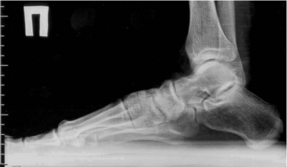 Osteoarthritis Finger und Füße